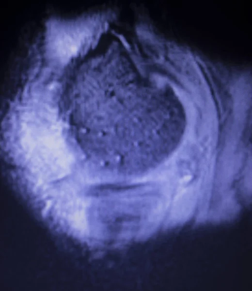Obrazowanie Rezonansu Magnetycznego Mri Kolana Tylnego Rogu Łąkotki Przyśrodkowej Łza — Zdjęcie stockowe