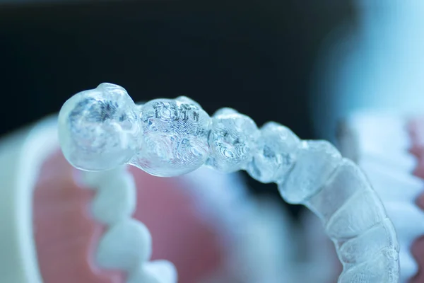 患者のための化粧品歯科の各歯を整列させるために使用される目に見えない歯科歯のアライナーブラケット — ストック写真