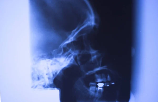 Медична Лікарня Рентгенівський Череп Обличчя Рот Зуби Ніс Очі Сканування — стокове фото