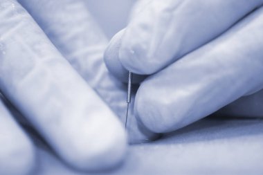 Fizyoterapi kliniği Doku İçi Perkütanöz Elektroliz EPI Kuru iğneli fizyoterapist yaralanması.