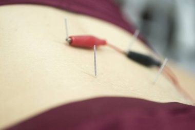 Fizyoterapi kliniği Doku İçi Perkütanöz Elektroliz EPI Kuru iğneli fizyoterapist yaralanması.