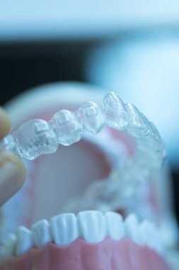 Kozmetik diş hekimliğinde hastalar için dişleri hizalamak için kullanılan görünmez diş düzenleyiciler.