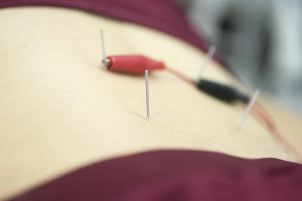 Physiotherapy clinic Intratissue Percutaneous Electrolysis EPI dry needling physiotherapist patient injury.