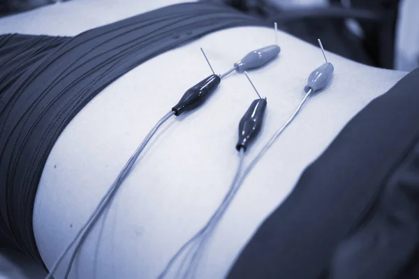 Fizyoterapi Kliniği Doku Perkütanöz Elektroliz Epi Kuru Iğneli Fizyoterapist Yaralanması — Stok fotoğraf