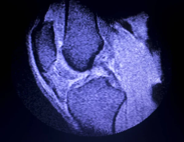 Mágneses Rezonancia Képalkotás Mri Térd Mediális Meniscus Hátsó Szarván Szakadás — Stock Fotó