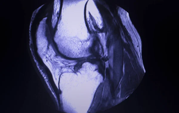 Magnetresonanztomographie Mri Knee Posterior Horn Medial Meniscus Tear Scantest Results — Stockfoto