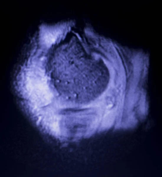 核磁気共鳴 Mri 膝後方ホーン内側半月板涙 Scantest — ストック写真