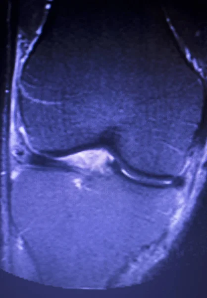 Ressonância Magnética Joelho Corno Posterior Menisco Medial Rasgo Resultados Escassos — Fotografia de Stock