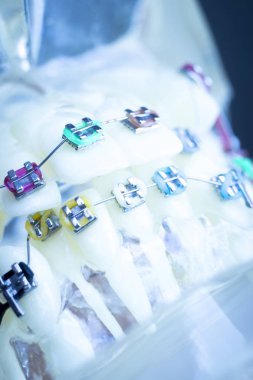 Diş metal diş teli Ortodonti modeli öğretim diş telini aligners.