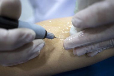 Fizyoterapi kliniği Doku İçi Perkütanöz Elektroliz EPI Kuru iğneli fizyoterapist yaralanması.