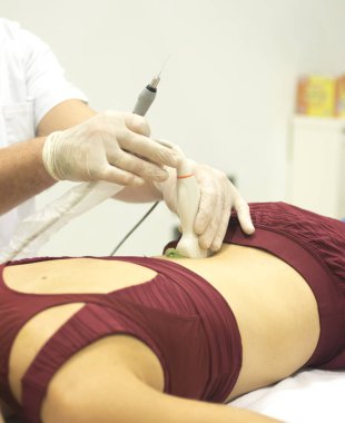 Fizyoterapi kliniği Doku İçi Perkütanöz Elektroliz EPI Kuru iğneli fizyoterapist yaralanması.