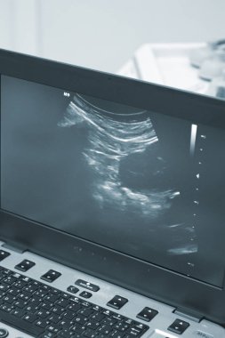 Fizyoterapi kliniği Doku İçi Perkütanöz Elektroliz EPI Kuru iğneli fizyoterapist yaralanması.