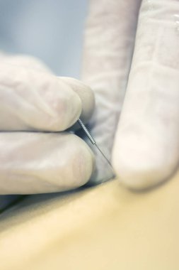 Fizyoterapi kliniği Doku İçi Perkütanöz Elektroliz EPI Kuru iğneli fizyoterapist yaralanması.