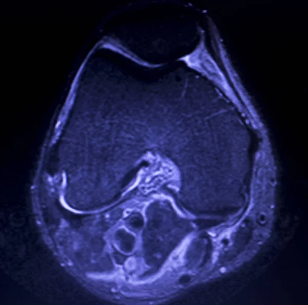 Magnetresonanztomographie Mri Knee Posterior Horn Medial Meniscus Tear Scantest Results — Stockfoto