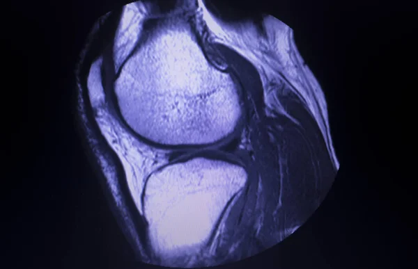 磁共振成像 Mri 膝关节后角内侧半月板撕裂扫描结果 — 图库照片