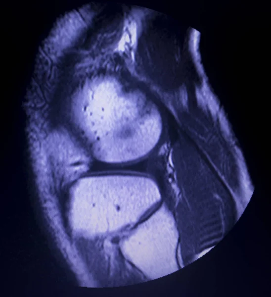 磁共振成像 Mri 膝关节后角内侧半月板撕裂扫描结果 — 图库照片