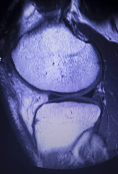 Obrazowanie Rezonansu Magnetycznego Mri Kolana Tylnego Rogu Łąkotki Przyśrodkowej Łza — Zdjęcie stockowe