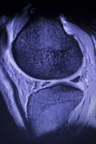 Magnetic resonance imaging MRI knee posterior horn medial meniscus tear scantest results.