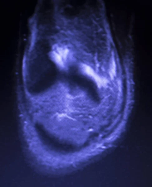 核磁気共鳴 Mri 膝後方ホーン内側半月板涙 Scantest — ストック写真