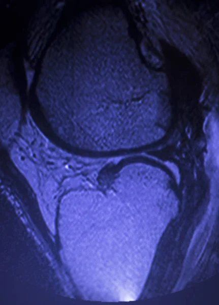 Ressonância Magnética Joelho Corno Posterior Menisco Medial Rasgo Resultados Escassos — Fotografia de Stock