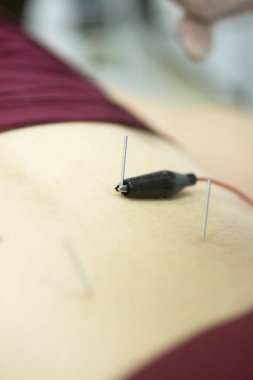 Fizyoterapi kliniği Doku İçi Perkütanöz Elektroliz EPI Kuru iğneli fizyoterapist yaralanması.