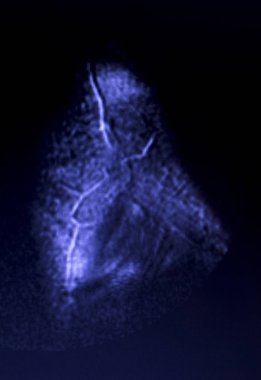 Manyetik rezonans görüntüleme MRG diz arka boynuz medial menisküs gözyaşı scantest sonuçları.