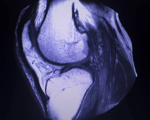 Magnetresonanztomographie Mri Knee Posterior Horn Medial Meniscus Tear Scantest Results — Stockfoto