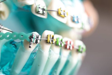 Diş metal diş teli Ortodonti modeli öğretim diş telini aligners.