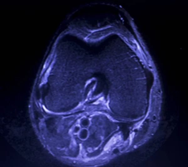 Μαγνητική Τομογραφία Mri Γόνατο Οπισθίου Κέρατος Έσω Μηνίσκου Δάκρυ Scantest — Φωτογραφία Αρχείου