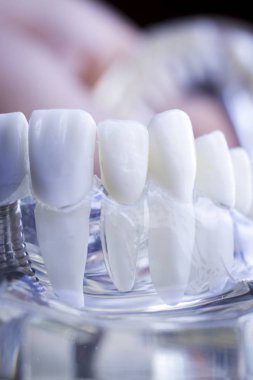 Diş hekimi diş diş implant