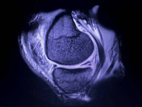 МРТ сканування меню розриву коліна — стокове фото