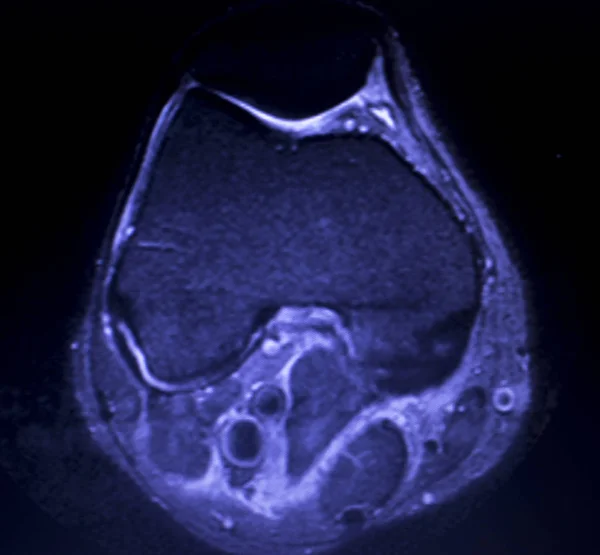 Mri の膝のメニスカスの裂け目スキャン — ストック写真