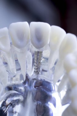 Diş hekimi diş diş implant