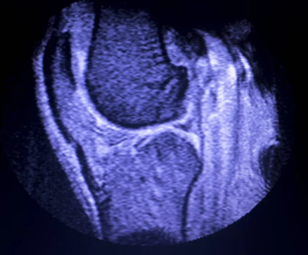 МРТ сканування меню розриву коліна — стокове фото