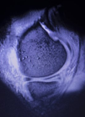 Mr diz menisküs gözyaşı tarama