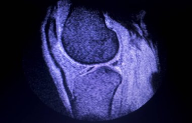 Mr diz menisküs gözyaşı tarama