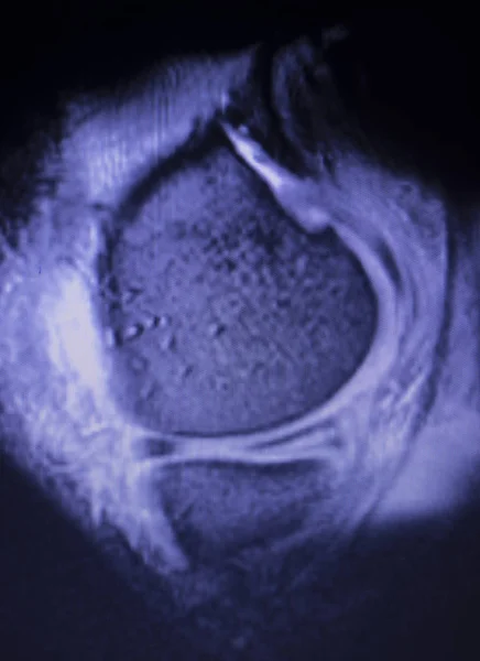 MRI knee meniscus tear scan — Stock Photo, Image