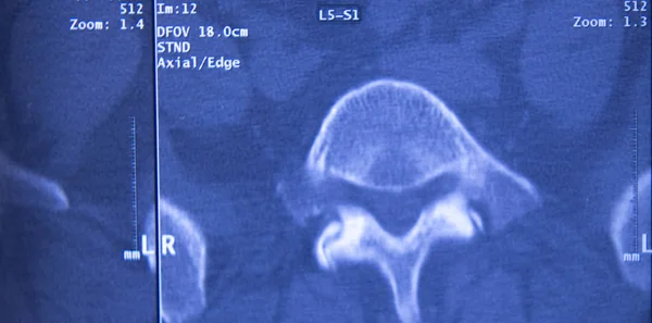 Cadera medica columna pelvis Resonancia magnética — Foto de Stock