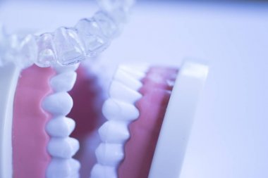 Görünmez diş diş aligners