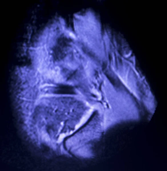 Ressonância magnética do menisco do joelho — Fotografia de Stock