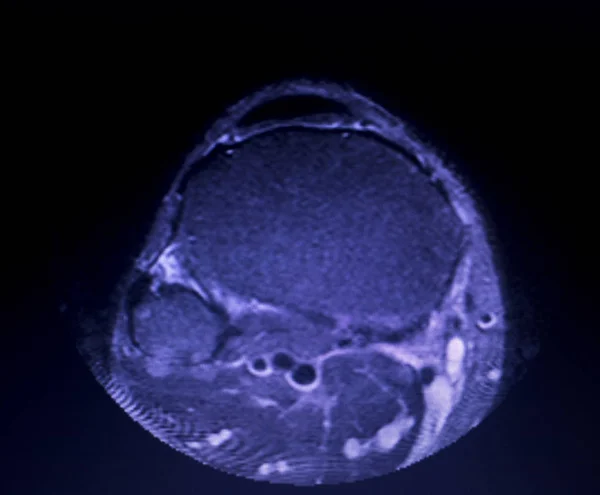 Mri 무릎 반 월 상 연골 눈물 스캔 — 스톡 사진