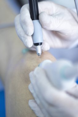 Epi lingling fizik tedavi