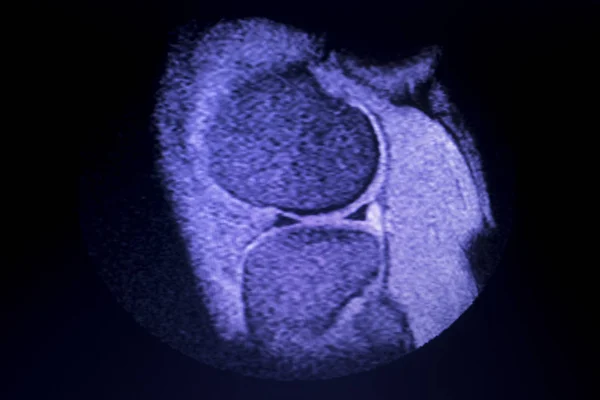 МРТ сканування меню розриву коліна — стокове фото