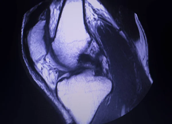 MRI knee meniscus tear scan — Stock Photo, Image