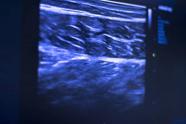 Сухое ультразвуковое сканирование эпинефрина — стоковое фото