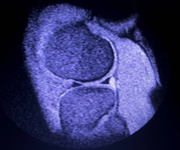 MRI menisku kolana łza skanowania — Zdjęcie stockowe