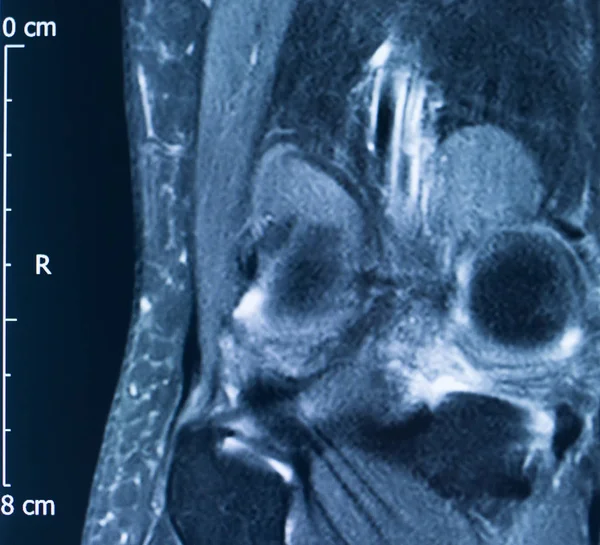 Травма колена mri mcl разрыв — стоковое фото
