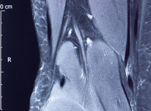 Térdsérülés MRI MCL könny — Stock Fotó