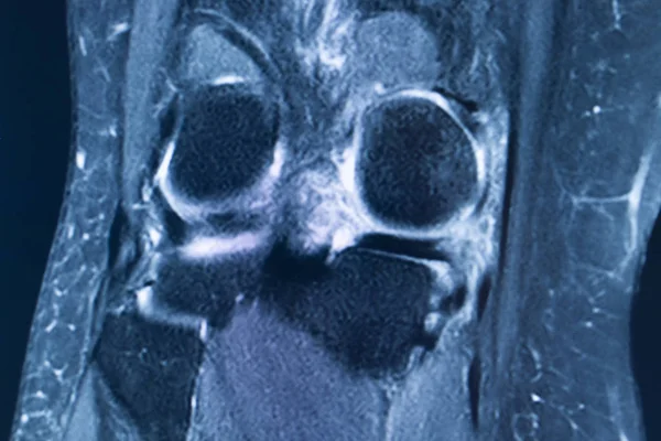 Diz yaralanması MRI MCL gözyaşı