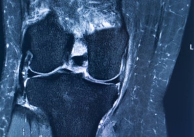 Diz yaralanması MRI MCL gözyaşı